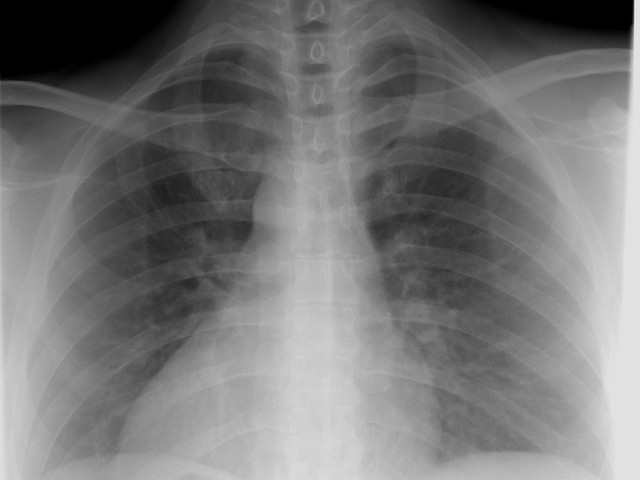 x-ray of lungs chest ribs