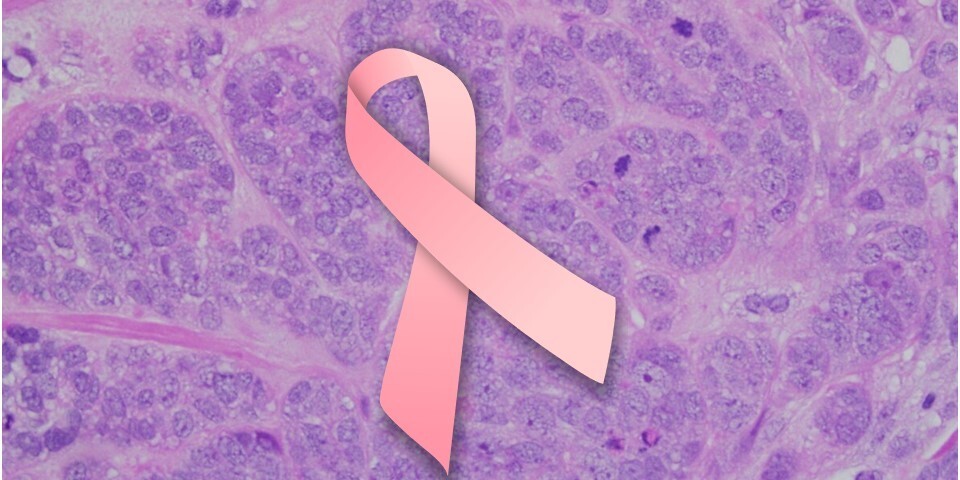 Image of pink breast cancer ribbon in front of a background of high-grade invasive ductal carcinoma cells.