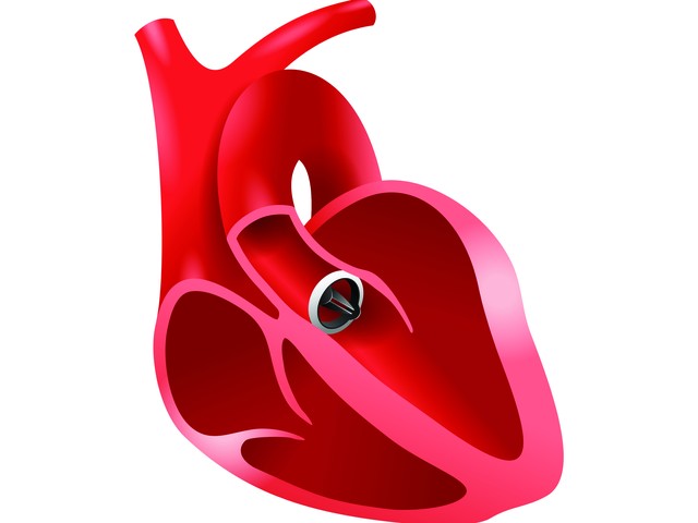 heart with valve replacement