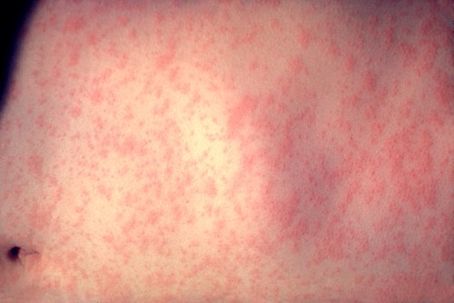 Picture of skin rash of person infected with measles.