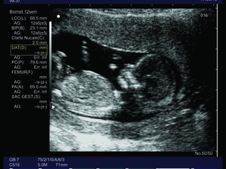 ultrasound