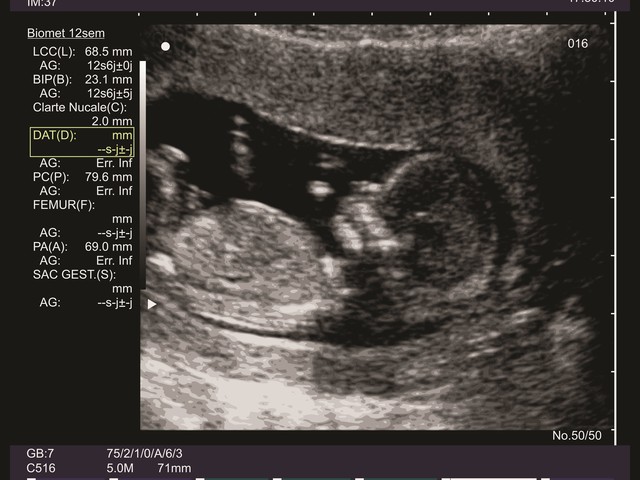 ultrasound
